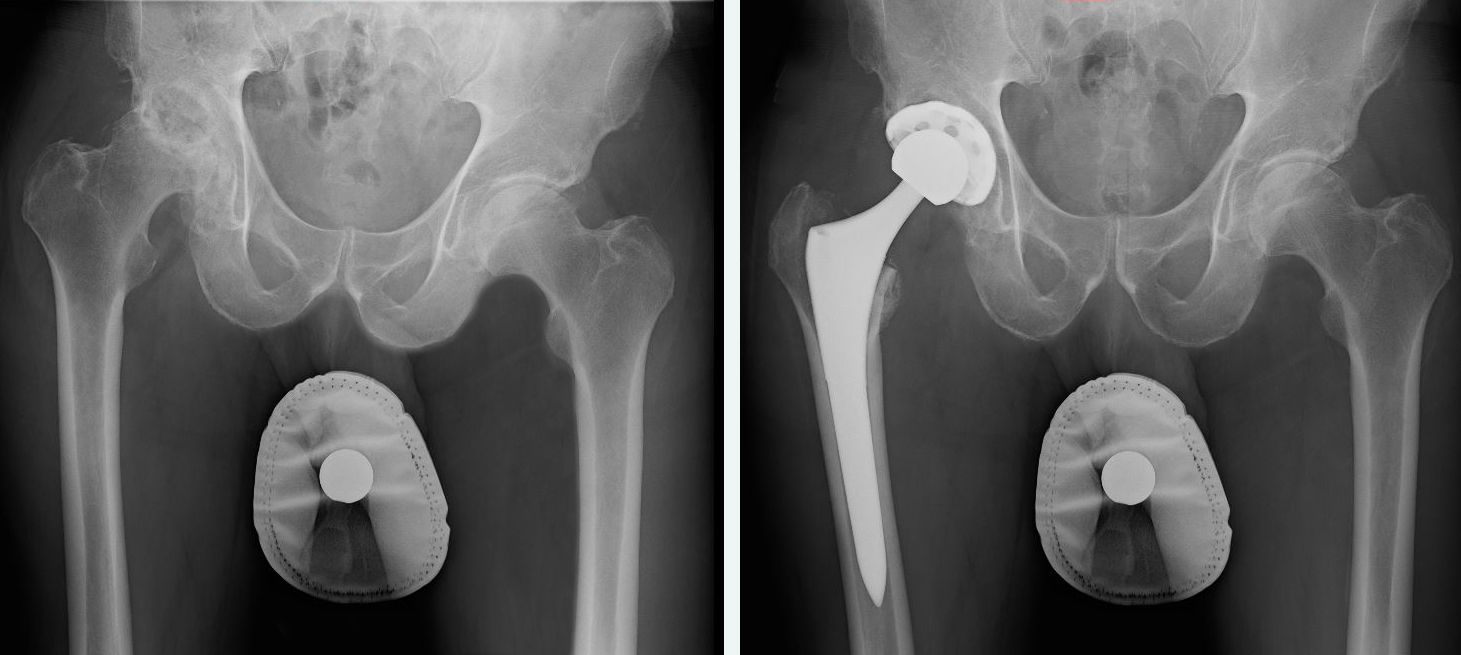 For Active Patients, Anterior Hip Replacement Surgery May Shorten