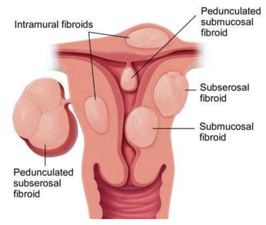 case study of uterine fibroids