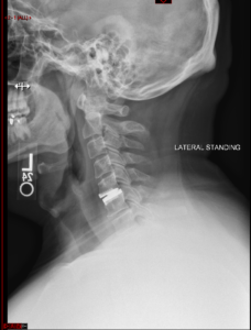 spine, disc replacement