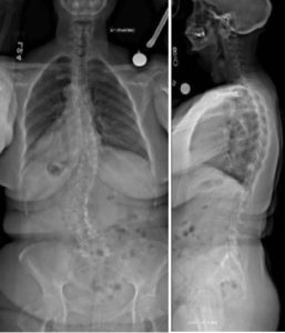 scoliosis xray