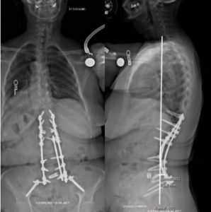 scoliosis2