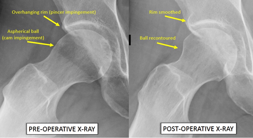 Before and after x-rays of hip socket