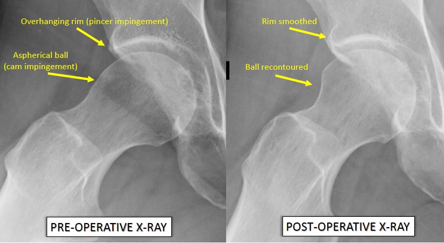 Case Arthroscopic Surgery for Femoroacetabular Impingement - Physician Resource