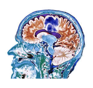brain scan of glioblastoma