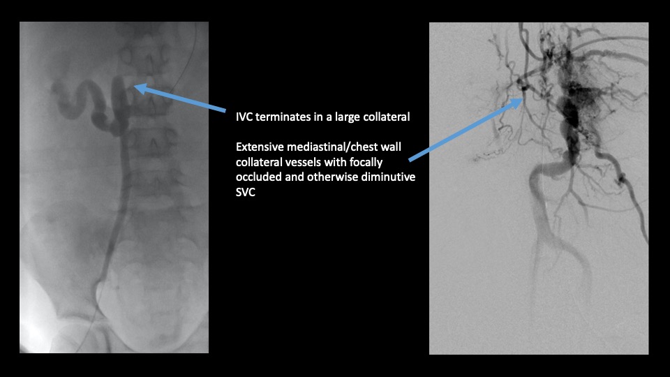 idiopathic thrombosis