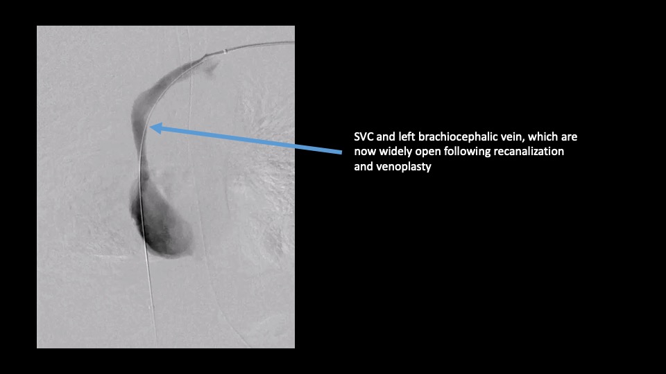 scan showing restored blood flow