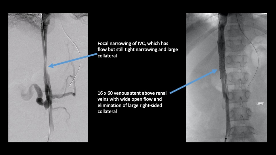 stent placement