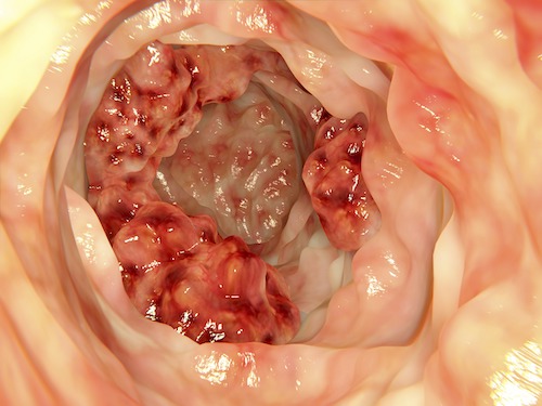 colon cancer, age of colon