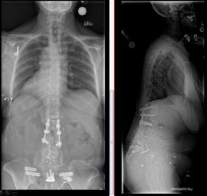 revision spine surgery