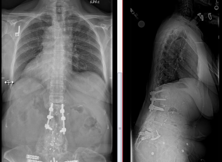 revision spine surgery