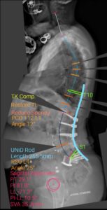spine case study