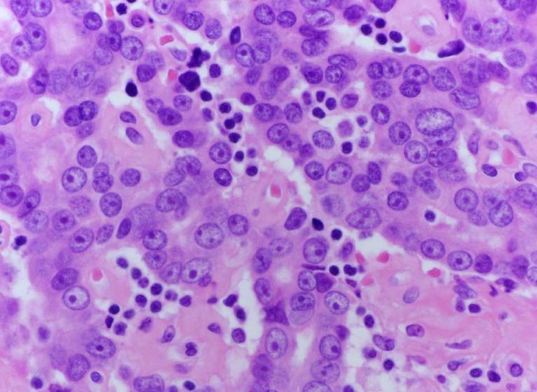 A microscopic slide of prostate cancer cells.