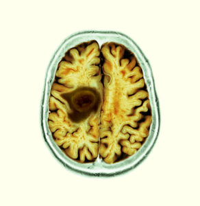 glioblastoma oncogene anvil focused ultrasound