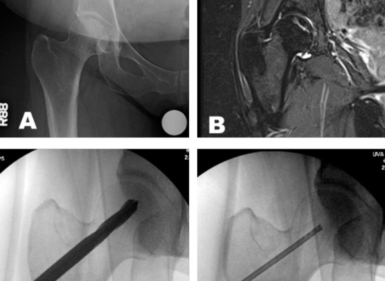 Imaging of the hip showing the femoral head and hip socket.