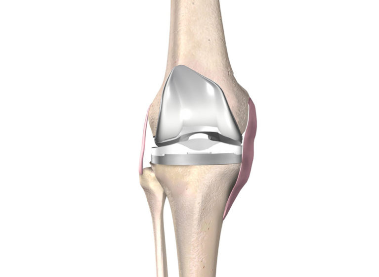 Knee implant illustration.