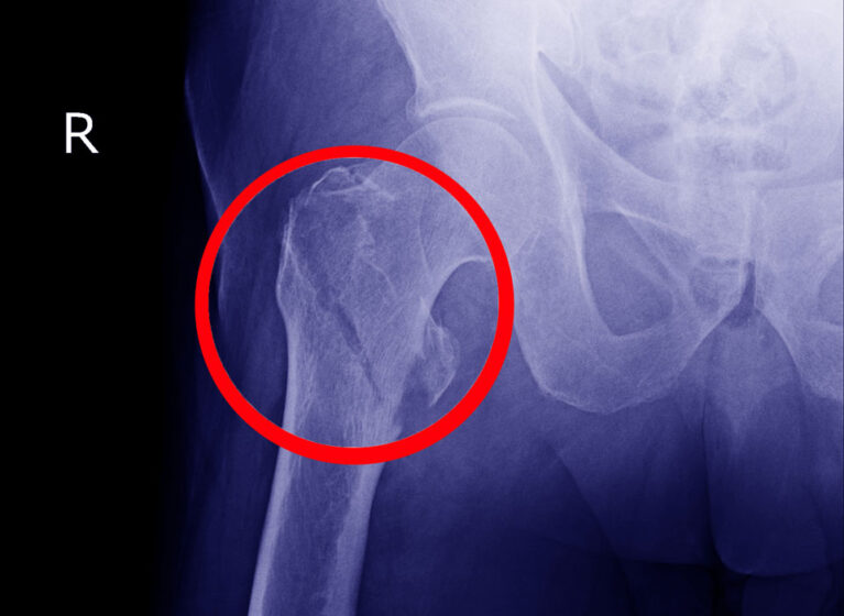 geriatric hip fracture