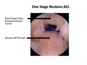 revision surgery for ACL reconstruction failure