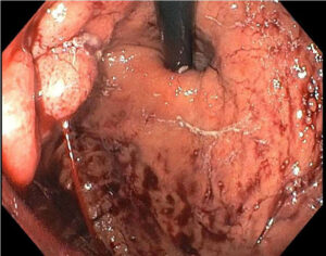 Treating gastric varices with endoscopic cyanoacrylate injection (ECI).