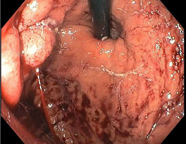 Treating gastric varices with endoscopic cyanoacrylate injection (ECI).
