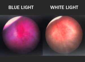 blue light cystoscopy improves bladder cancer outcomes