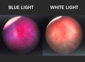 blue light cystoscopy improves bladder cancer outcomes