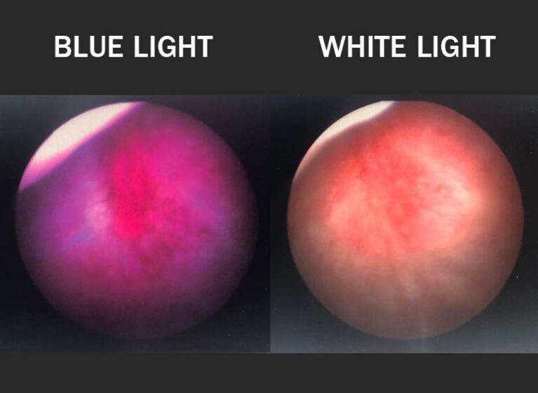 blue light cystoscopy improves bladder cancer outcomes