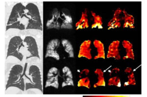 CT vs HXeMRI chest scans
