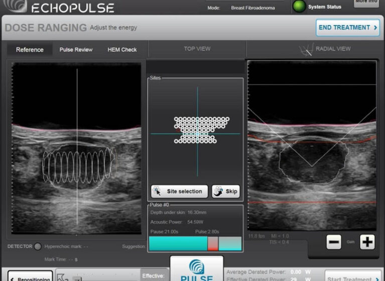 focused ultrasound