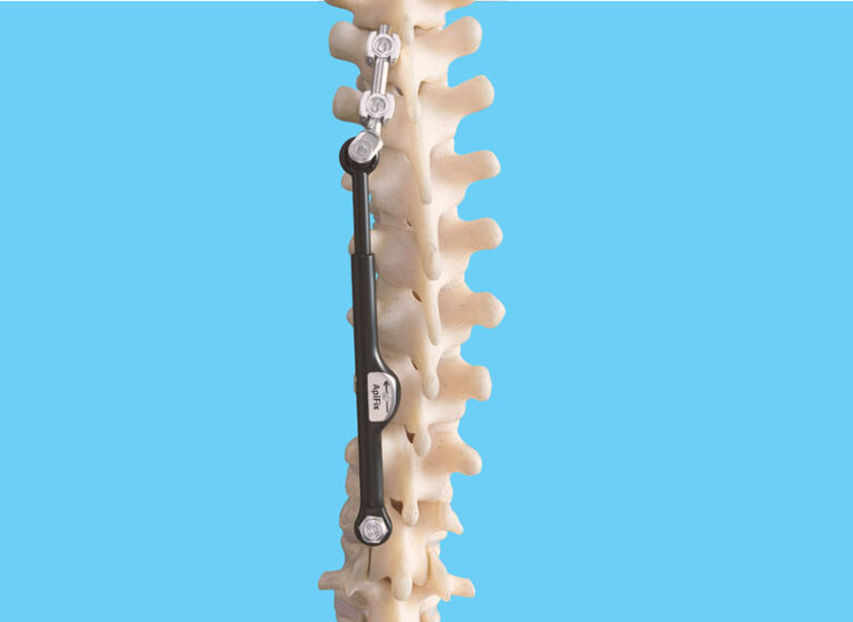 The ApiFix growth modulation device attached to a model spine.