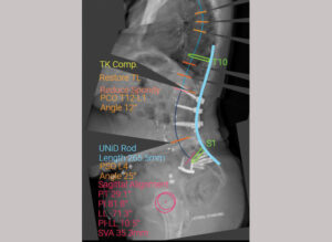 A X-ray of the spine in a 74-year-old spine revision surgery patient.
