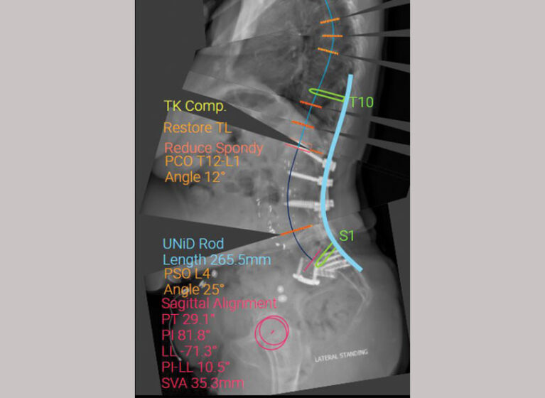 A X-ray of the spine in a 74-year-old spine revision surgery patient.