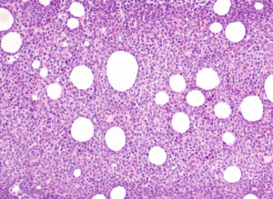 non-hodgkin large b cell lymphoma