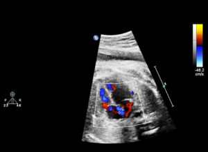 fetal echocardiogram image