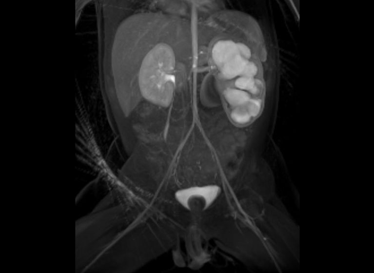 A magnetic resonance urography scan