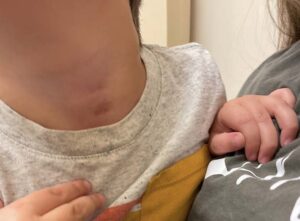 throat with minimal scarring