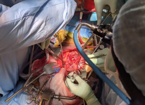 cystectomy surgery