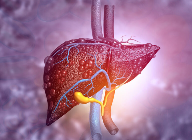 cirrhosis of the liver