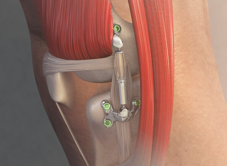 Image of new implantable shock absorber