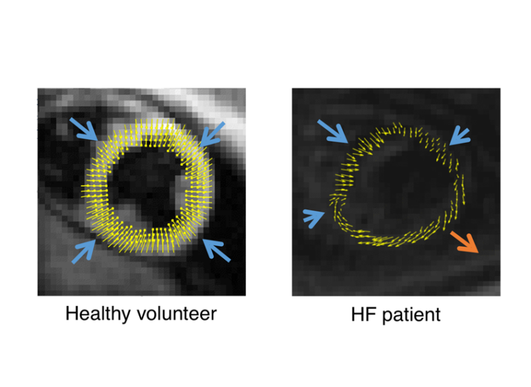 Imaging in a patient with normal heart processes and one with heart failure