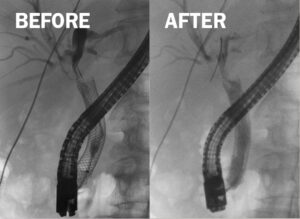 Before and after images show an endobiliary ablation