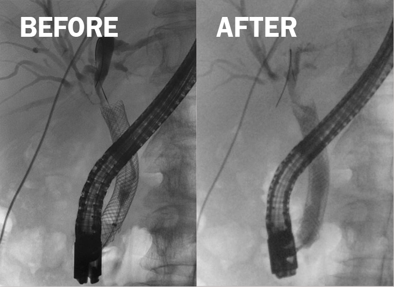 Endobiliary Ablation Optimizes Care for Biliary Cancers