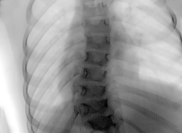 x-ray shows spine with scoliosis
