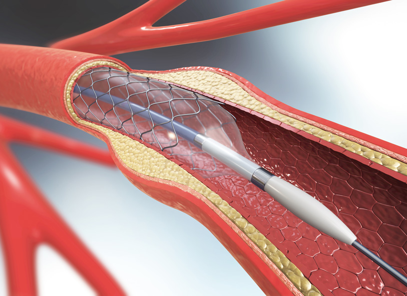 Preventing In-Stent Restenosis with New Technology