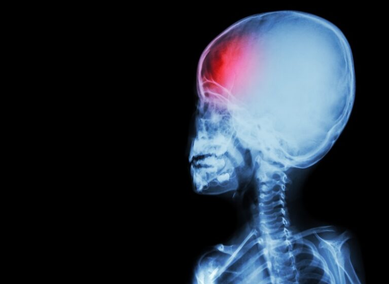 x-ray of child with headache before neurosurgery